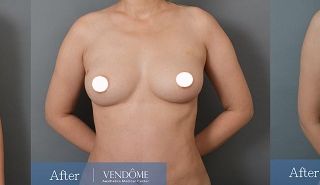 療程效果因人而異，上圖為C罩杯產後女性在做完自體脂肪隆乳之後​手術後一個月、手術後兩個月成效